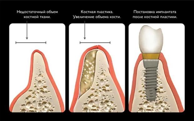 Наращивание костной ткани